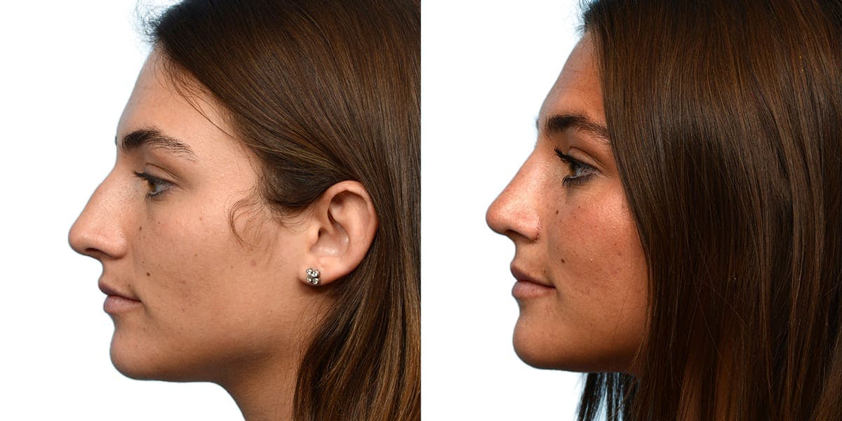 Rhinoplasty Before & After Gallery - Patient 206740 - Image 3
