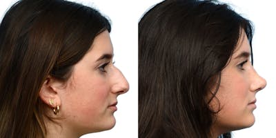 Rhinoplasty Before & After Gallery - Patient 314168 - Image 1