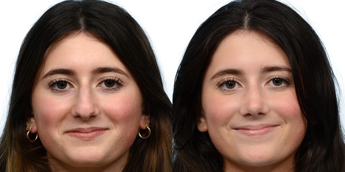 Rhinoplasty Before & After Gallery - Patient 314168 - Image 2
