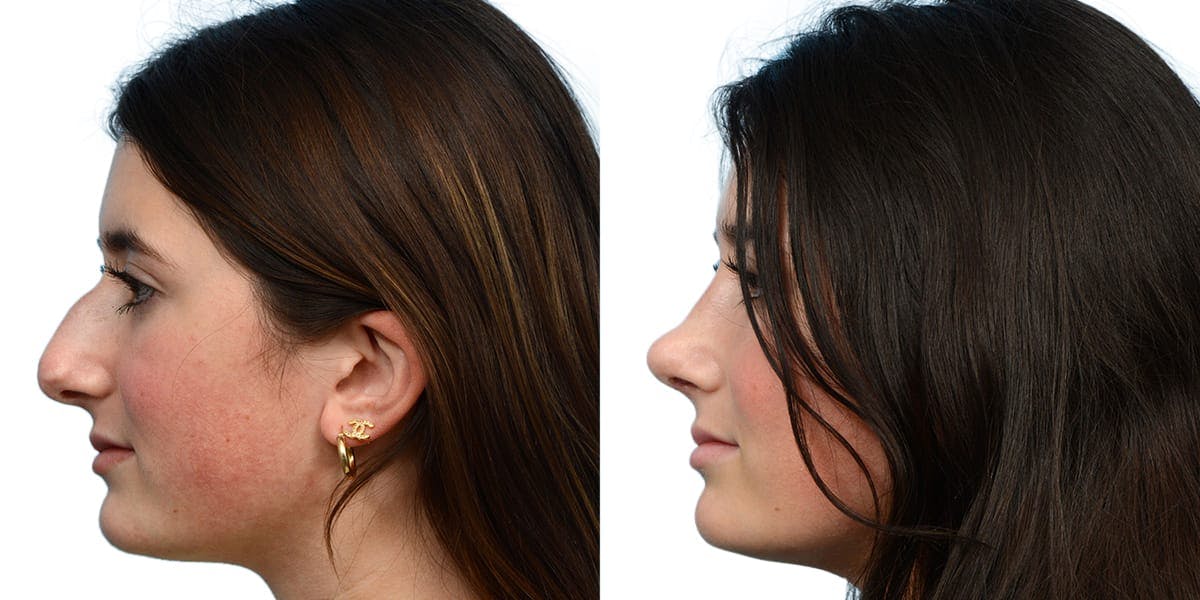Rhinoplasty Before & After Gallery - Patient 314168 - Image 3