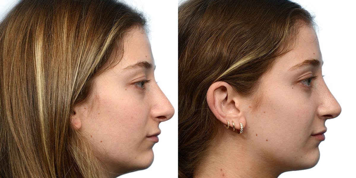 Rhinoplasty Before & After Gallery - Patient 101774 - Image 1