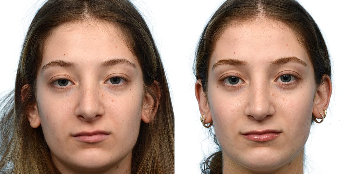 Rhinoplasty Before & After Gallery - Patient 101774 - Image 2