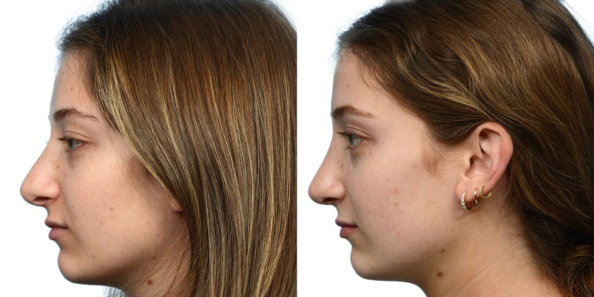 Rhinoplasty Before & After Gallery - Patient 101774 - Image 3