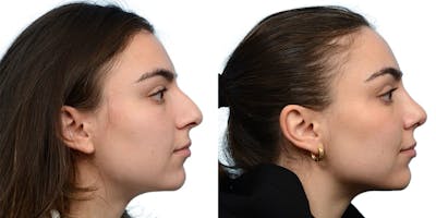 Rhinoplasty Before & After Gallery - Patient 351319 - Image 1