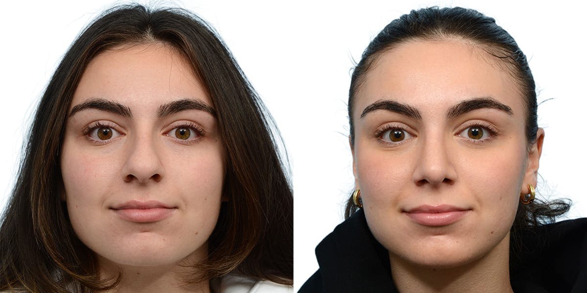 Rhinoplasty Before & After Gallery - Patient 351319 - Image 2