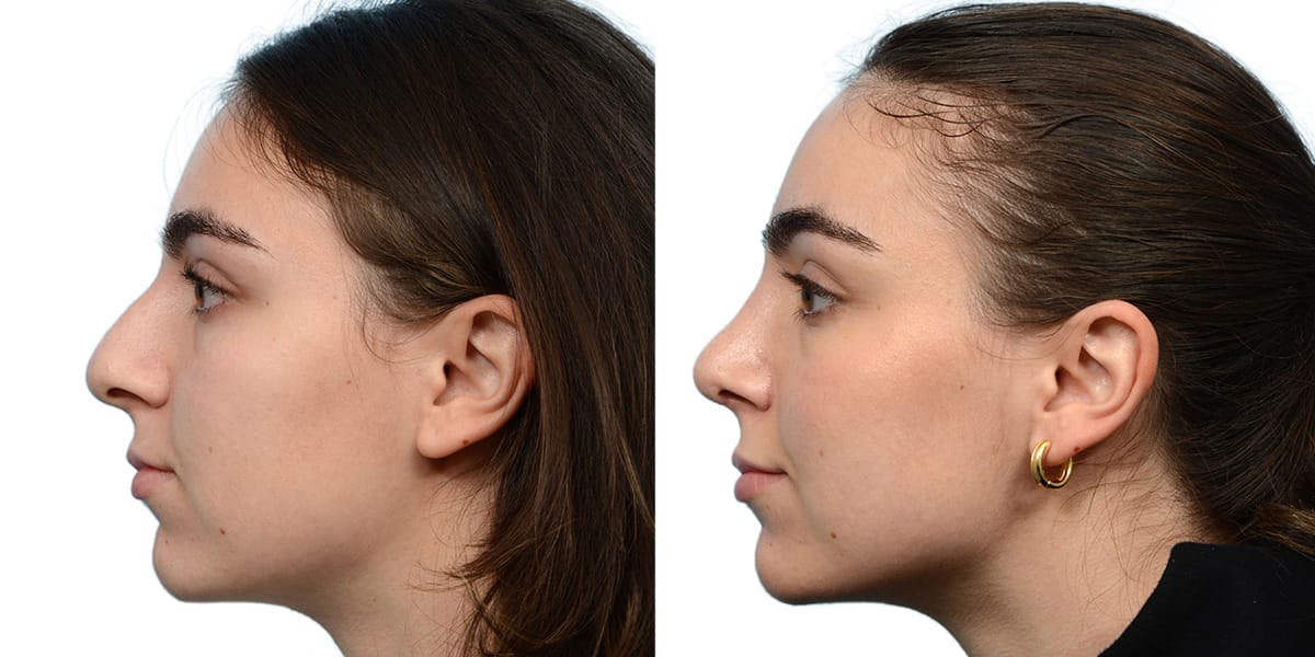 Rhinoplasty Before & After Gallery - Patient 351319 - Image 3