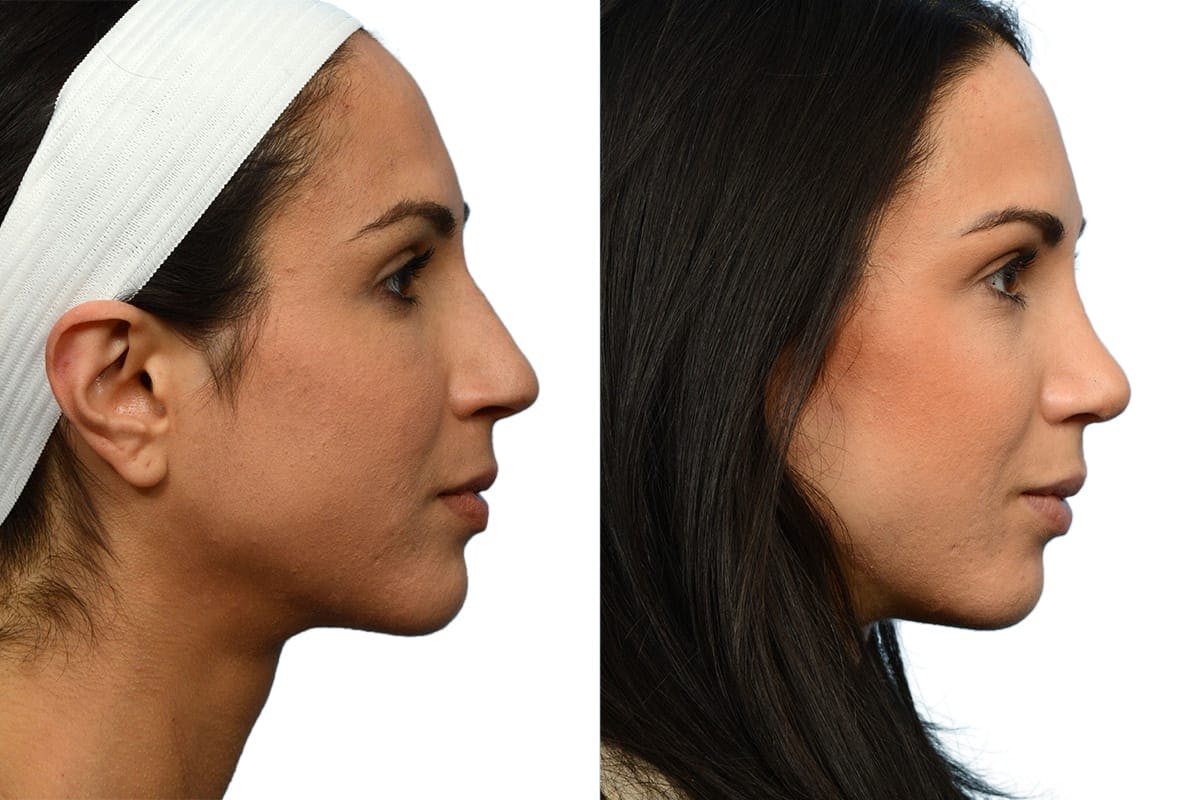 Rhinoplasty Before & After Gallery - Patient 189604 - Image 1