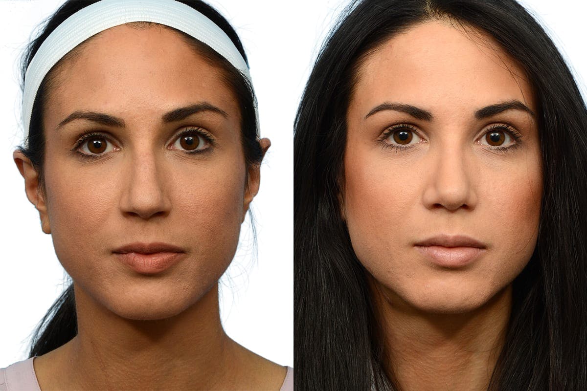 Rhinoplasty Before & After Gallery - Patient 189604 - Image 2