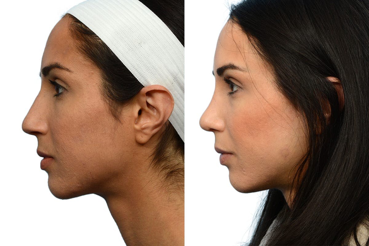 Rhinoplasty Before & After Gallery - Patient 189604 - Image 3