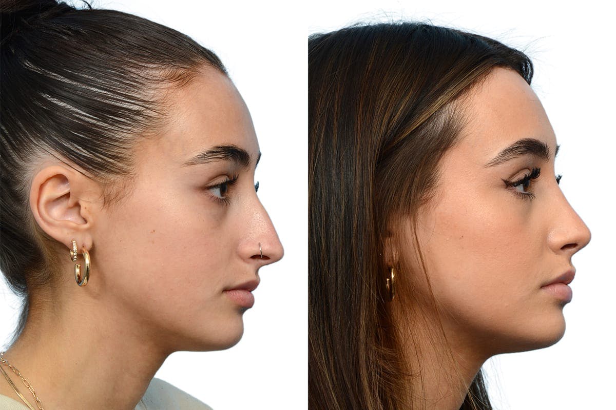 Rhinoplasty Before & After Gallery - Patient 264989 - Image 1