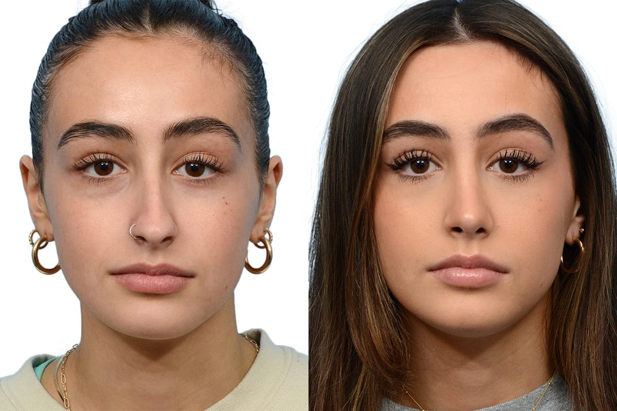 Rhinoplasty Before & After Gallery - Patient 264989 - Image 2