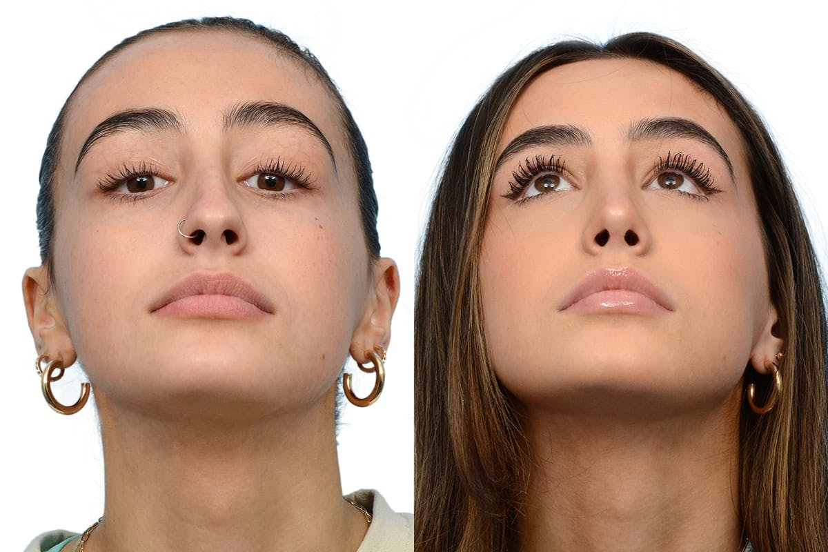 Rhinoplasty Before & After Gallery - Patient 264989 - Image 3
