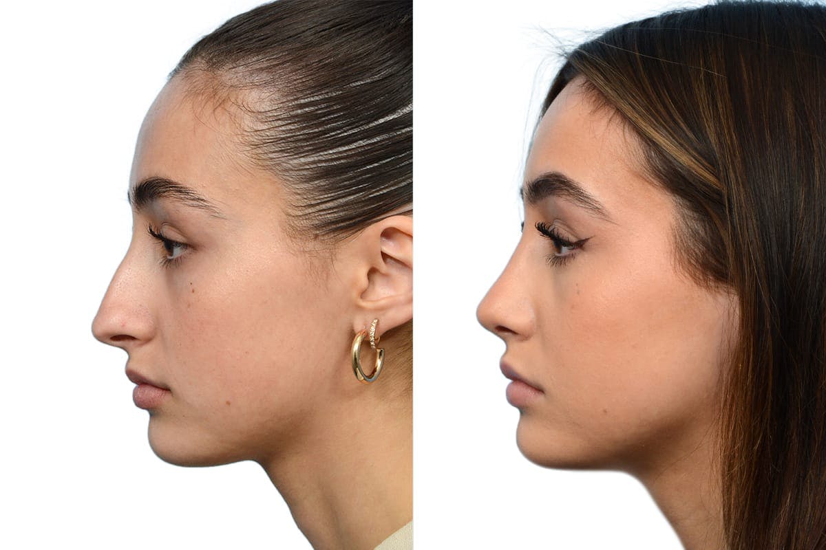 Rhinoplasty Before & After Gallery - Patient 264989 - Image 4