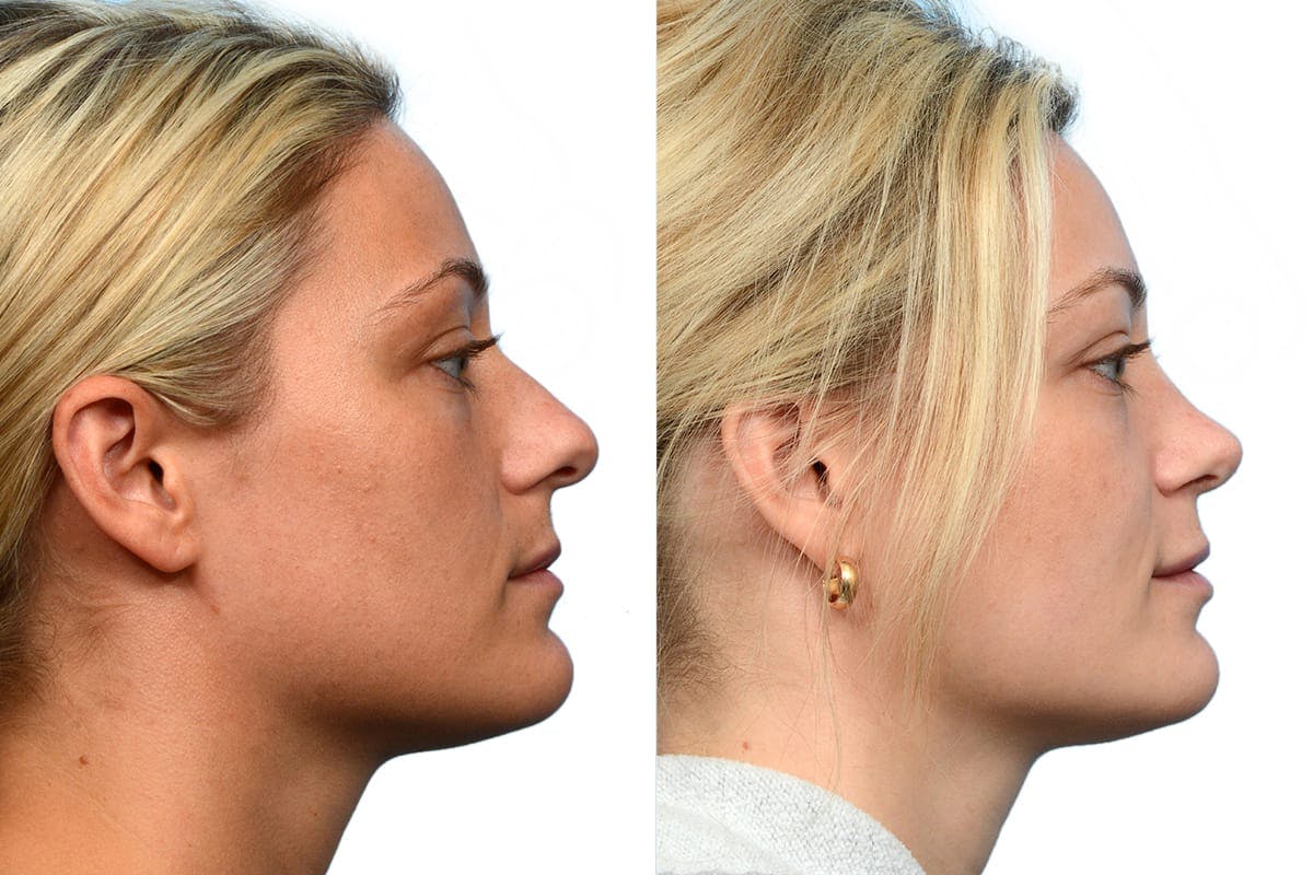 Rhinoplasty Before & After Gallery - Patient 194524 - Image 1