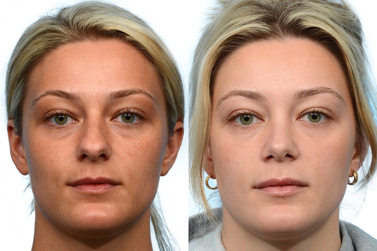 Rhinoplasty Before & After Gallery - Patient 194524 - Image 2