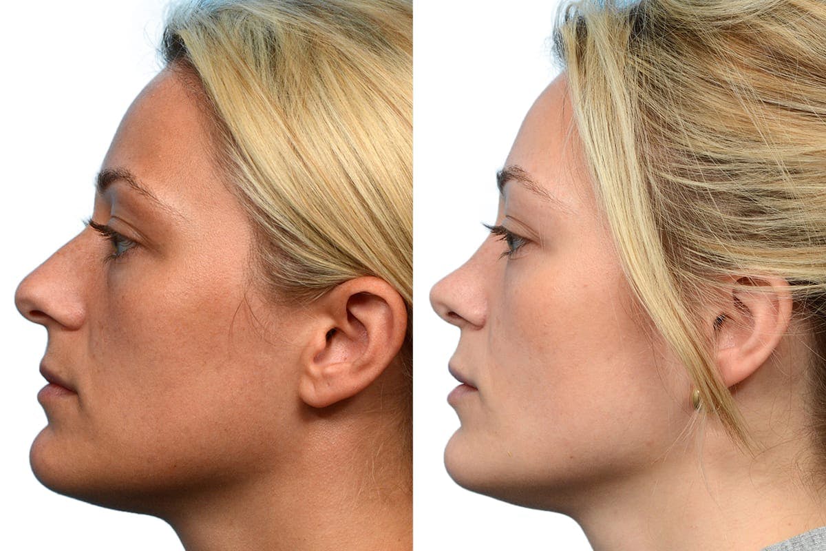 Rhinoplasty Before & After Gallery - Patient 194524 - Image 3
