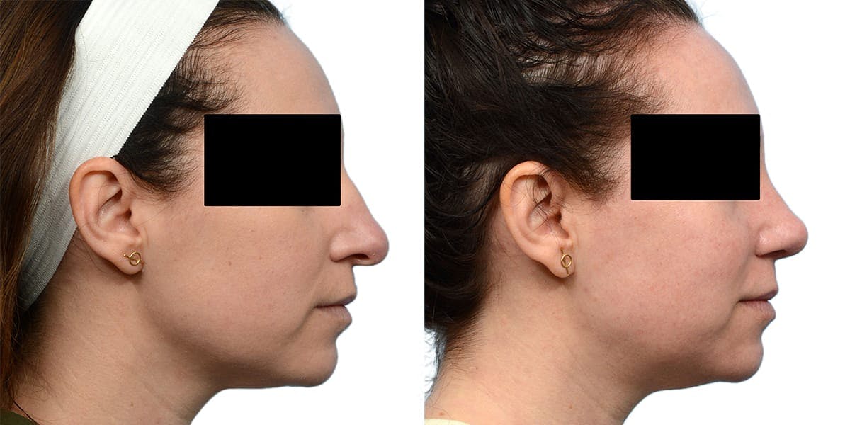 Rhinoplasty Before & After Gallery - Patient 143909 - Image 1