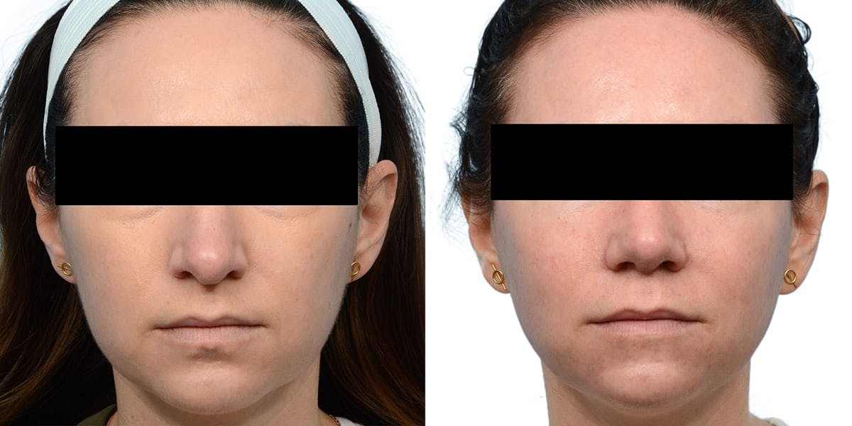 Rhinoplasty Before & After Gallery - Patient 143909 - Image 2