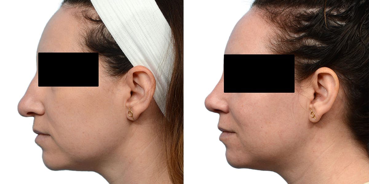Rhinoplasty Before & After Gallery - Patient 143909 - Image 3