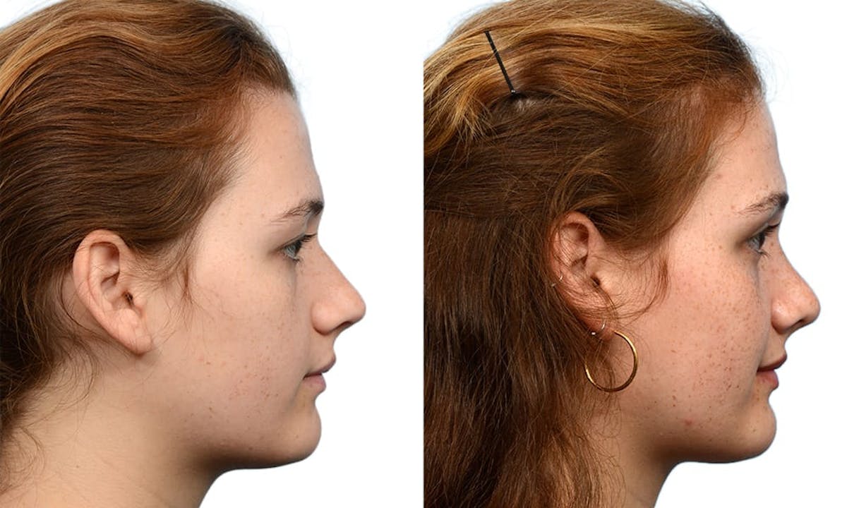 Rhinoplasty Before & After Gallery - Patient 229677 - Image 1