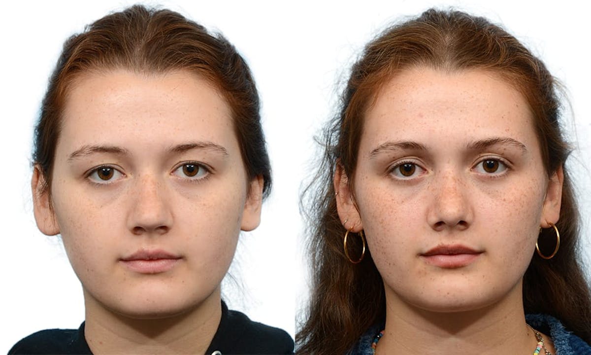 Rhinoplasty Before & After Gallery - Patient 229677 - Image 2