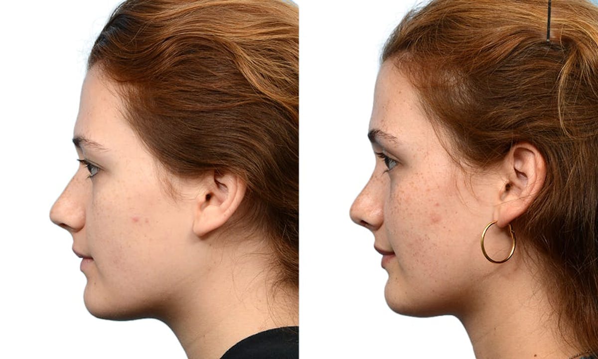 Rhinoplasty Before & After Gallery - Patient 229677 - Image 3