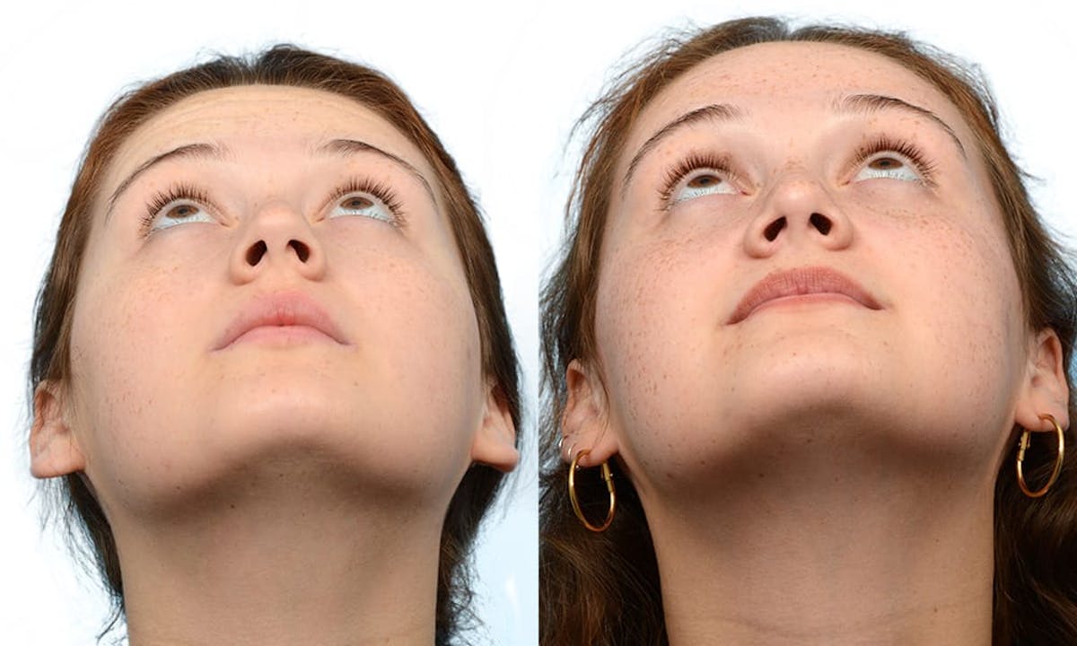 Rhinoplasty Before & After Gallery - Patient 229677 - Image 4