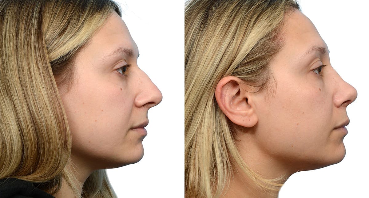 Rhinoplasty Before & After Gallery - Patient 413925 - Image 1