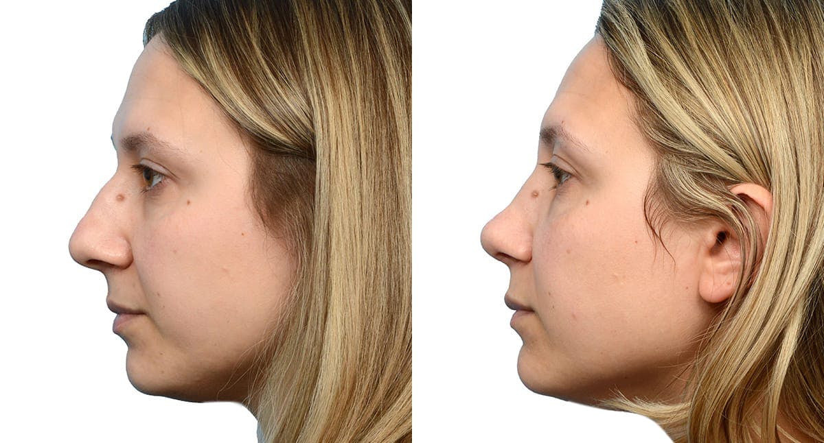 Rhinoplasty Before & After Gallery - Patient 413925 - Image 2
