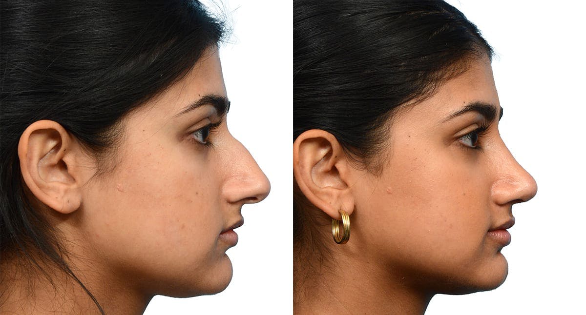 Rhinoplasty Before & After Gallery - Patient 143915 - Image 1
