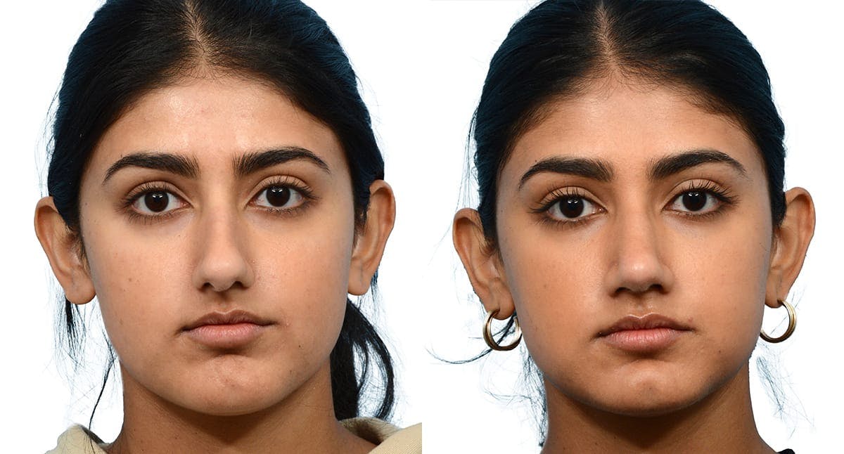 Rhinoplasty Before & After Gallery - Patient 143915 - Image 3