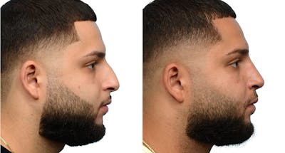 Rhinoplasty Before & After Gallery - Patient 258659 - Image 1
