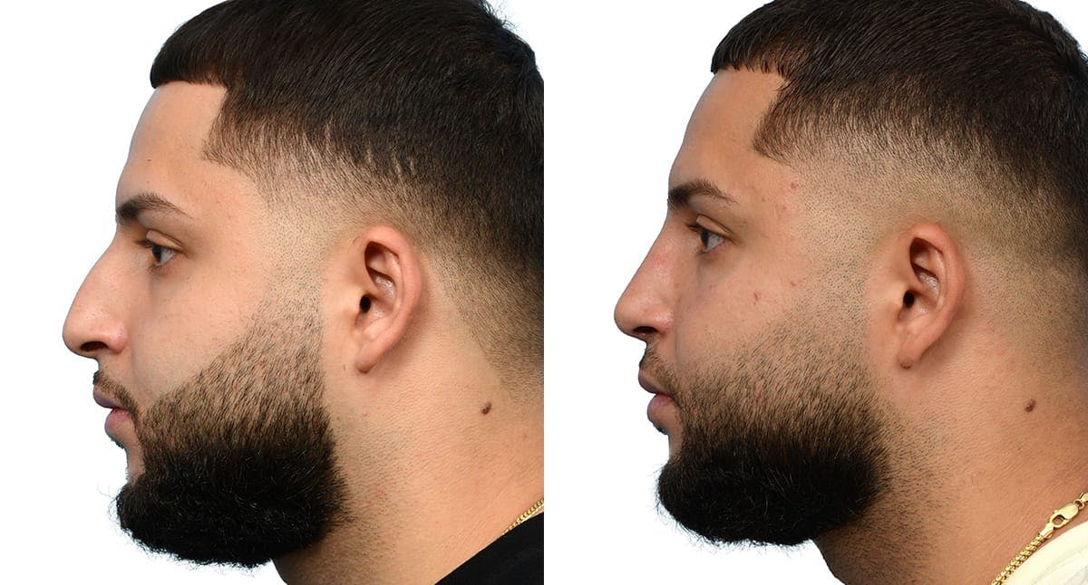 Rhinoplasty Before & After Gallery - Patient 258659 - Image 2