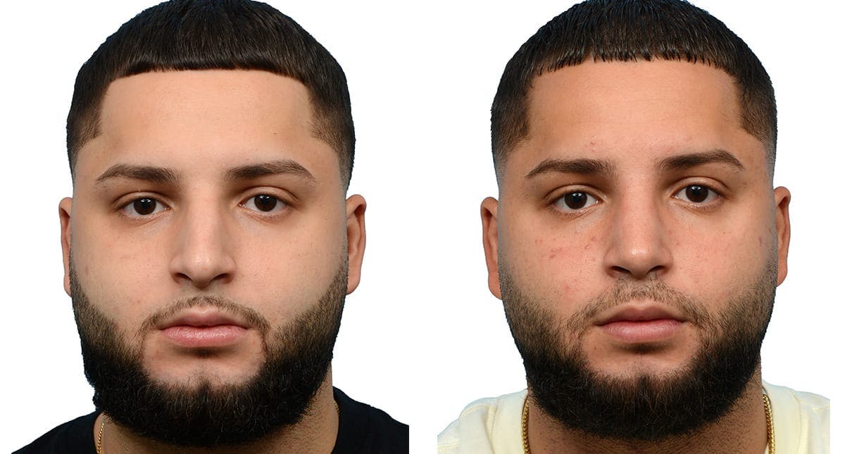 Rhinoplasty Before & After Gallery - Patient 258659 - Image 3