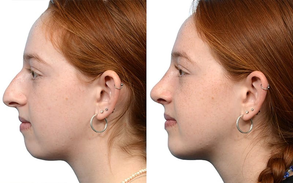 Rhinoplasty Before & After Gallery - Patient 152902 - Image 2