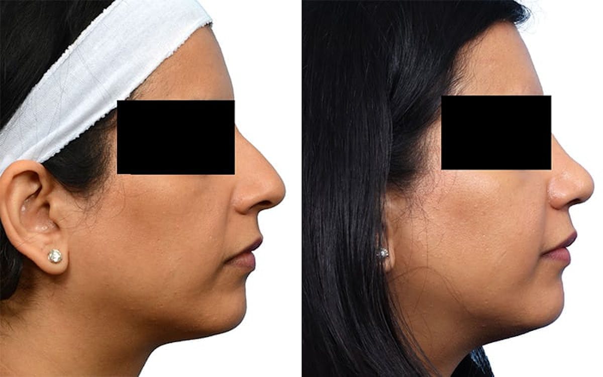 Ethnic Rhinoplasty