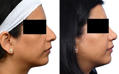 Rhinoplasty Before & After Gallery - Patient 361472 - Image 1