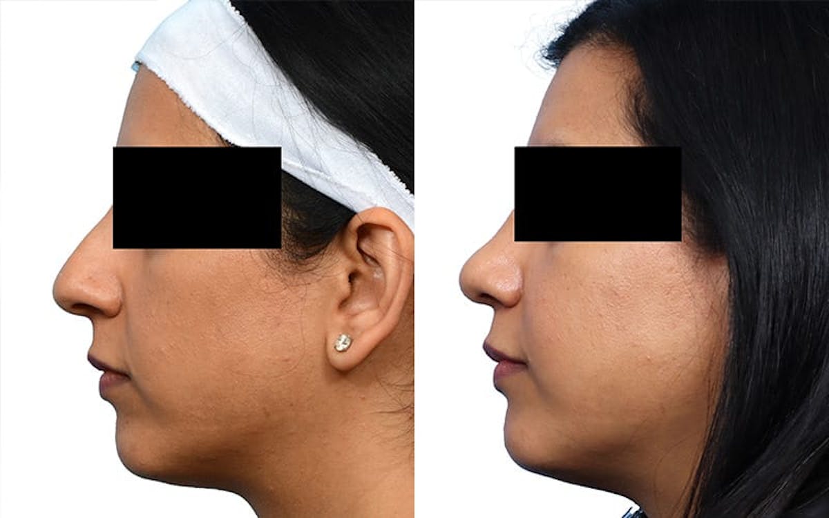 Rhinoplasty Before & After Gallery - Patient 361472 - Image 2