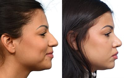 Rhinoplasty Before & After Gallery - Patient 571956 - Image 1