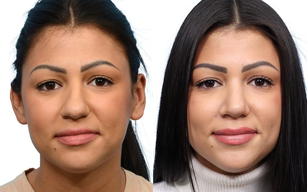 Rhinoplasty Before & After Gallery - Patient 571956 - Image 2