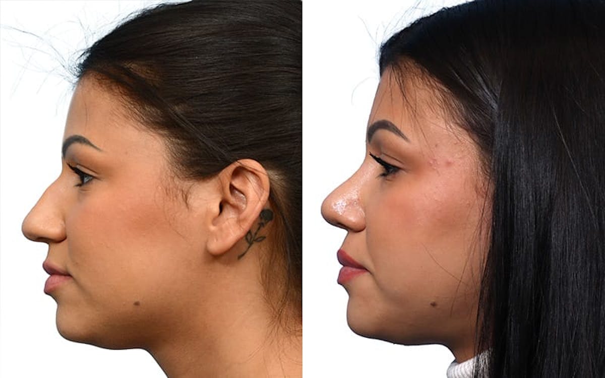 Rhinoplasty Before & After Gallery - Patient 571956 - Image 3