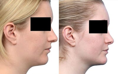 Rhinoplasty Before & After Gallery - Patient 215090 - Image 1
