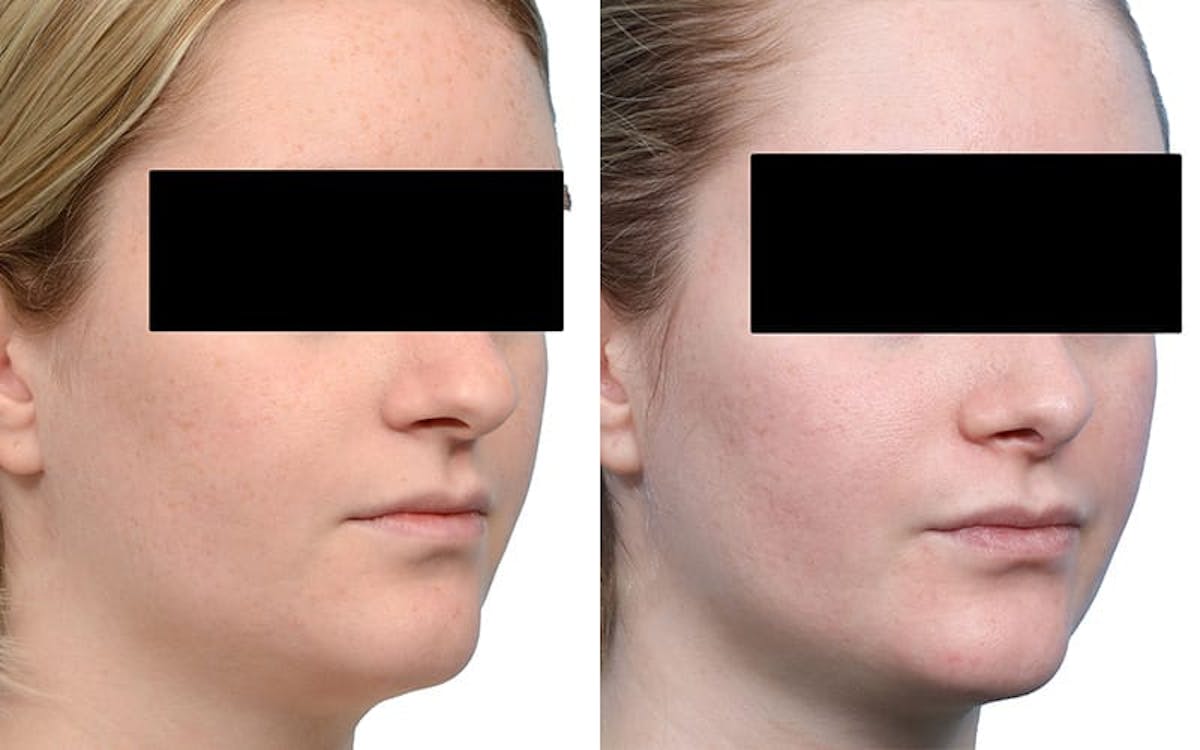 Rhinoplasty Before & After Gallery - Patient 215090 - Image 2