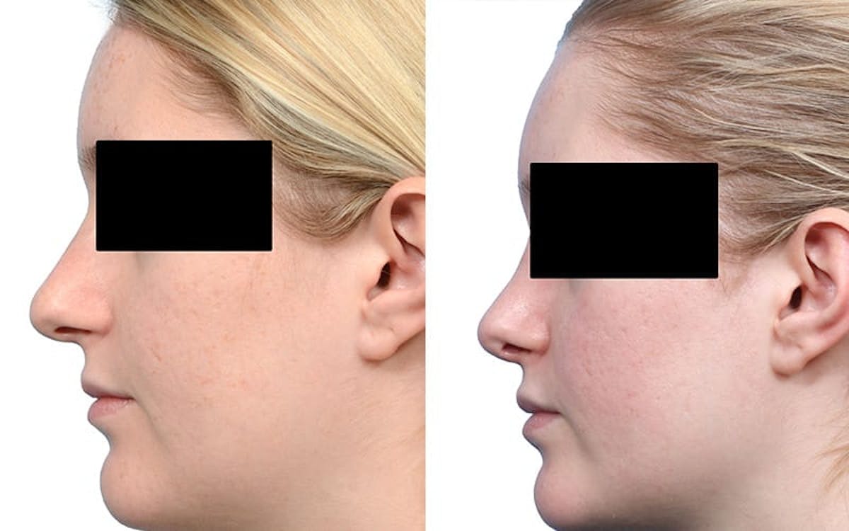 Rhinoplasty Before & After Gallery - Patient 215090 - Image 3