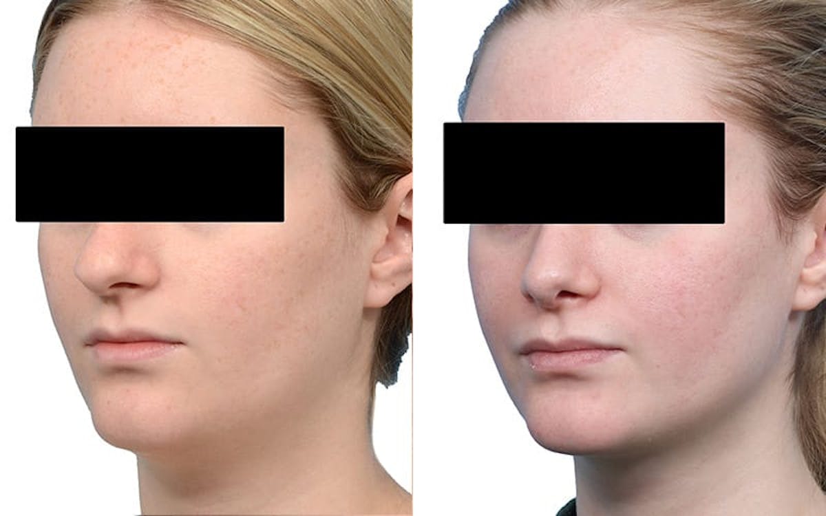 Rhinoplasty Before & After Gallery - Patient 215090 - Image 4