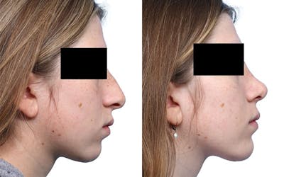Rhinoplasty Before & After Gallery - Patient 416767 - Image 1