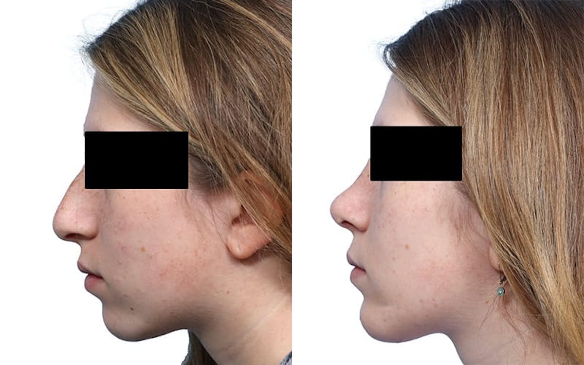Rhinoplasty Before & After Gallery - Patient 416767 - Image 2