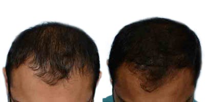 FUE Hair Transplant Before & After Gallery - Patient 304264 - Image 1
