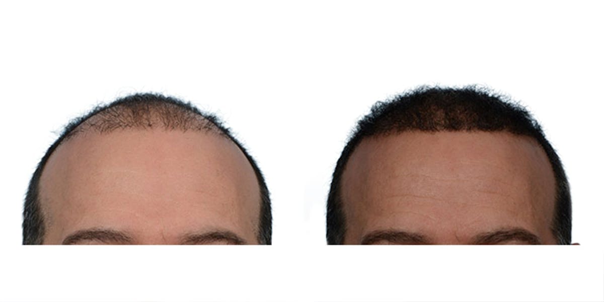 FUE Hair Transplant Before & After Gallery - Patient 804662 - Image 1