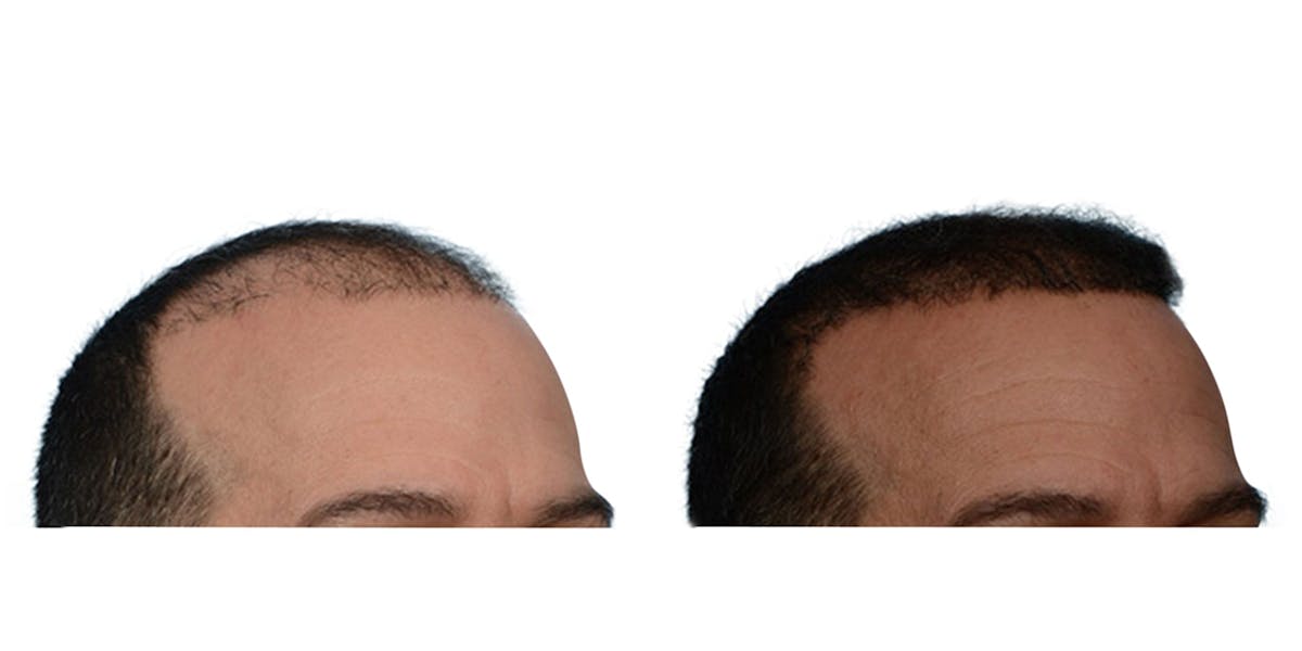 FUE Hair Transplant Before & After Gallery - Patient 804662 - Image 2